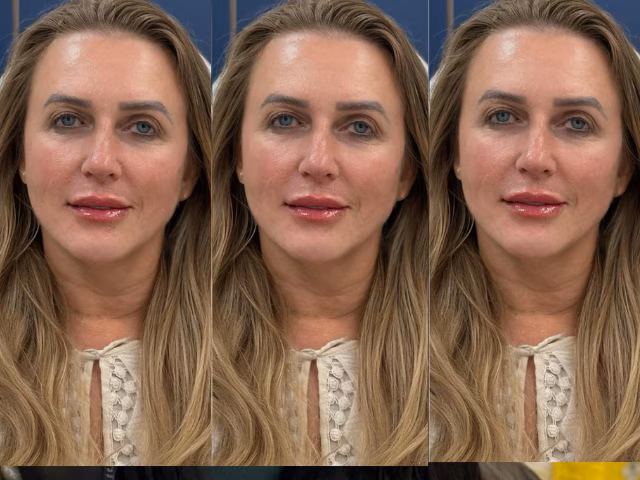 Depois do procedimento Face Full