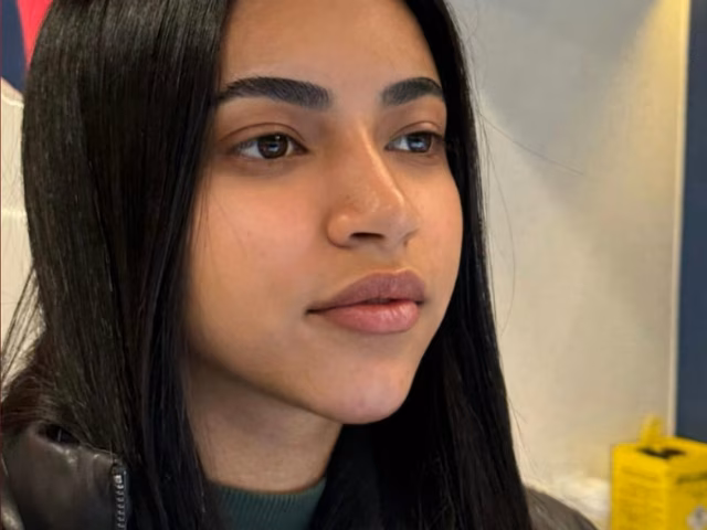 Depois do procedimento Perfil: mento, nariz e boca