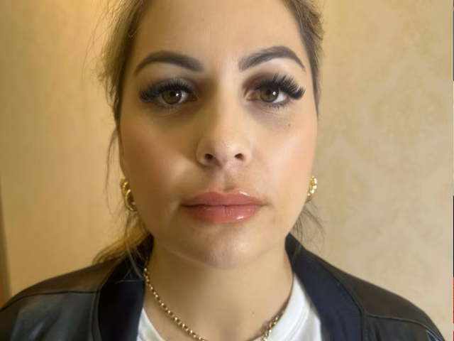 Depois do procedimento Preenchimento Labial