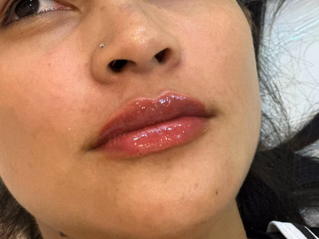 Depois do procedimento Preenchimento de Labial